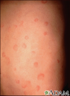 Hives (urticaria) on the back - Illustration Thumbnail                      