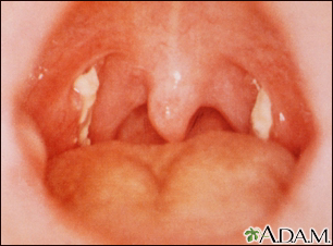 Mononucleosis - view of the throat - Illustration Thumbnail                      