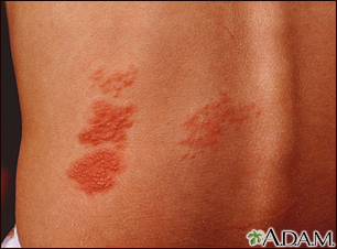 Herpes zoster (shingles) on the back - Illustration Thumbnail                      
