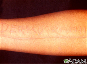 Dermatographism - arm - Illustration Thumbnail                      