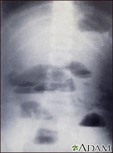Small bowel obstruction - X-ray - Illustration Thumbnail                      