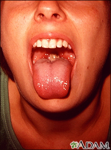Mononucleosis - mouth - Illustration Thumbnail                      