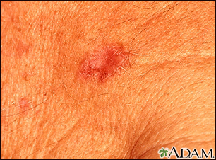 Basal Cell Carcinoma - close-up - Illustration Thumbnail                      