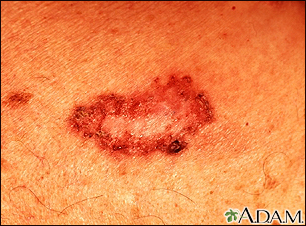 Basal cell carcinoma - close-up - Illustration Thumbnail                      