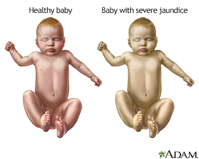 Infant jaundice - Indication