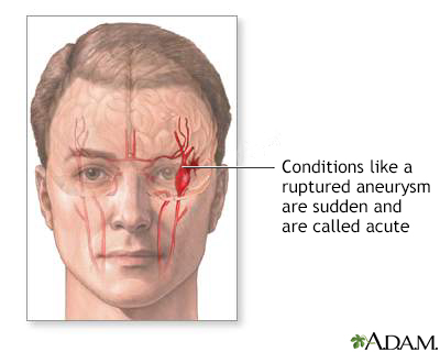 Ruptured intracranial aneurysm - Illustration Thumbnail                      