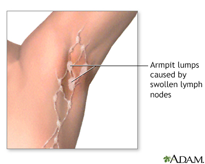 Swollen lymph nodes under arm - Illustration Thumbnail                      