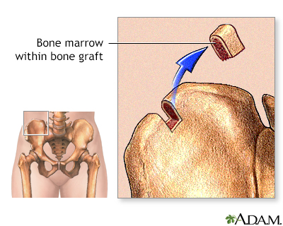 Bone marrow from hip - Illustration Thumbnail                      