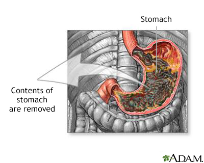 Gastric suction - Illustration Thumbnail                      