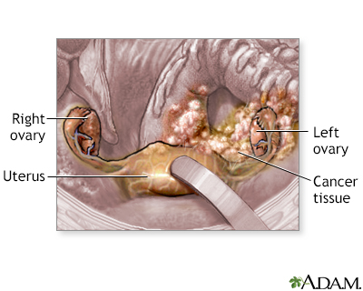 Ovarian cancer - Illustration Thumbnail                      