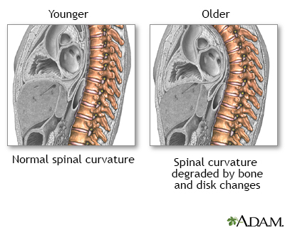Changes in spine with age - Illustration Thumbnail                      