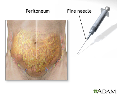 Peritoneal sample - Illustration Thumbnail                      