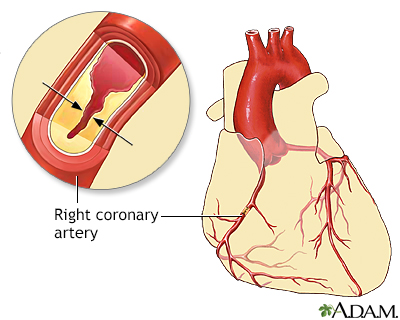 Coronary artery disease - Illustration Thumbnail                      