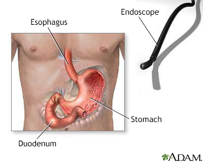 Gastric endoscopy - Illustration Thumbnail                      