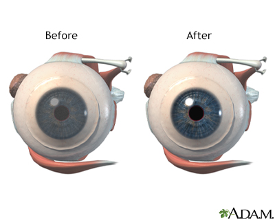 Before and after corneal surgery - Illustration Thumbnail                      