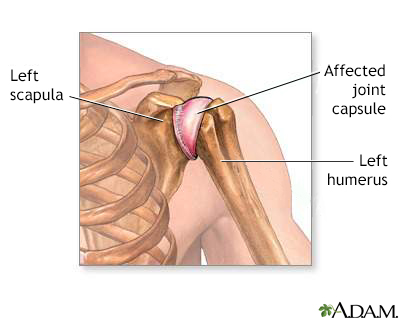 Shoulder joint inflammation - Illustration Thumbnail                      