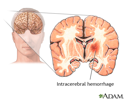 Intracerebral hemorrhage - Illustration Thumbnail                      