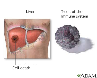 Liver cell death - Illustration Thumbnail                      