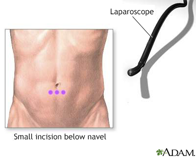 Incision for abdominal laparoscopy - Illustration Thumbnail                      