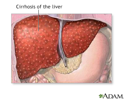 Cirrhosis of the liver - Illustration Thumbnail                      