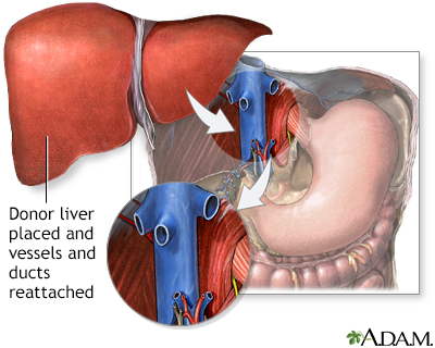 Donor liver attachment - Illustration Thumbnail                      