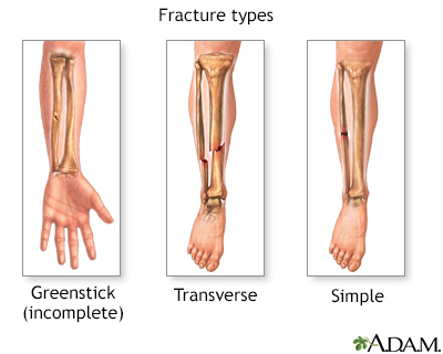 Fracture types (2) - Illustration Thumbnail                      