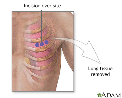 Incision for lung biopsy - Illustration Thumbnail                      