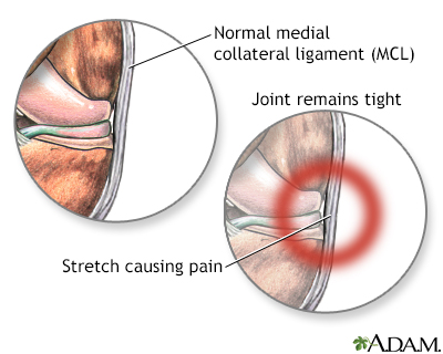 Medial collateral ligament pain - Illustration Thumbnail                      