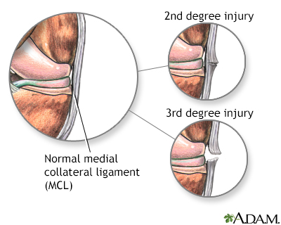 Medial collateral ligament injury - Illustration Thumbnail                      
