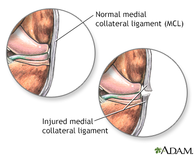 Torn medial collateral ligament - Illustration Thumbnail                      