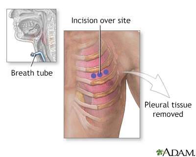 Incision for pleural tissue biopsy - Illustration Thumbnail                      