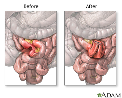 Before and after small intestine anastomosis - Illustration Thumbnail                      