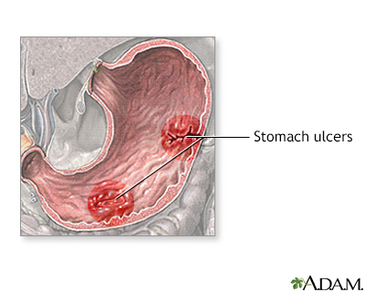 Stomach disease or trauma - Illustration Thumbnail                      