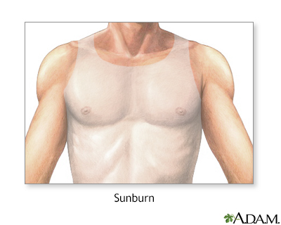 Sunburn - Illustration Thumbnail                      
