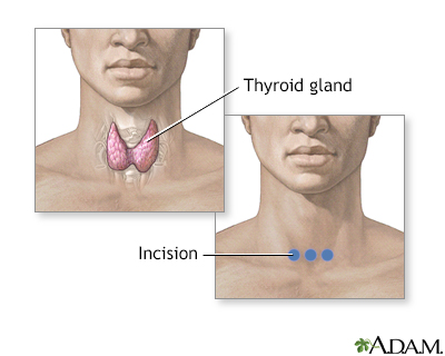 Incision for thyroid gland surgery - Illustration Thumbnail                      