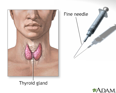 Thyroid gland biopsy - Illustration Thumbnail                      