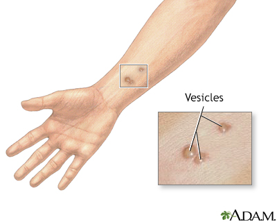 Vesicles - Illustration Thumbnail                      