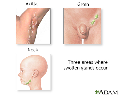 Swollen glands - Illustration Thumbnail                      