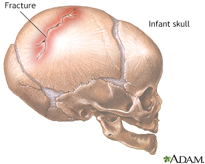 Infant skull fracture - Illustration Thumbnail                      