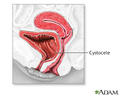Cystocele - Illustration Thumbnail                      