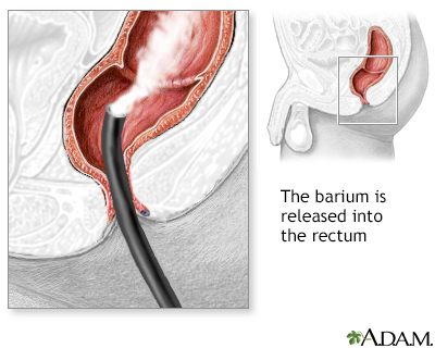 Barium enema - Illustration Thumbnail                      
