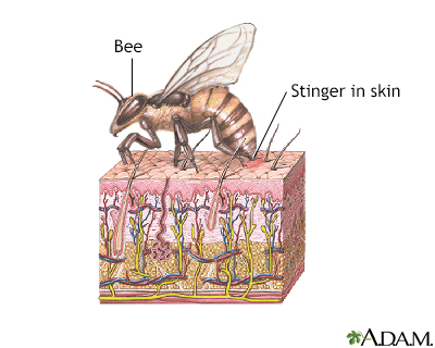 Bee sting - Illustration Thumbnail                      