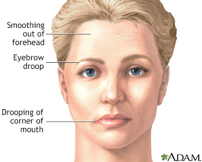 Facial drooping - Illustration Thumbnail                      