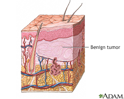 Benign tumor of the skin - Illustration Thumbnail                      