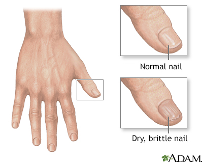 Brittle nails - Illustration Thumbnail                      