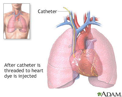 Cardiac catheterization - Illustration Thumbnail                      