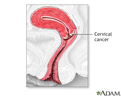 Cervical cancer - Illustration Thumbnail                      