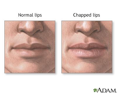 Chapped lips - Illustration Thumbnail                      