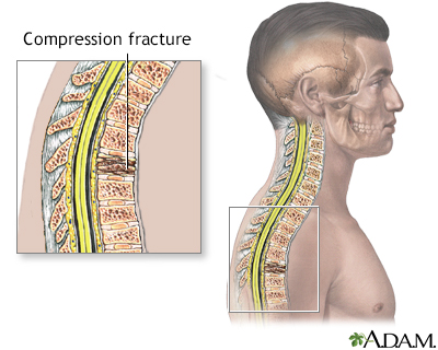 Compression fracture - Illustration Thumbnail                      