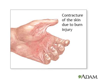 Contracture deformity - Illustration Thumbnail                      